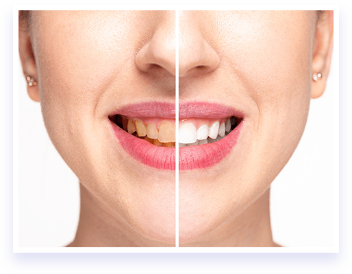 Teeth 
Natural Teeth Whitener - 100% Working